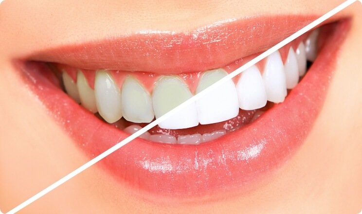 teeth whitening