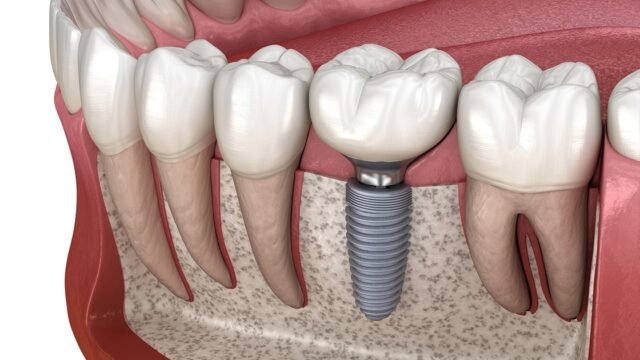 What are dental implants? Types, procedures, and more/ChurchStreetDental