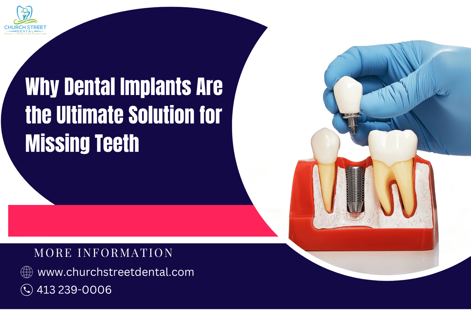 Dental Implants