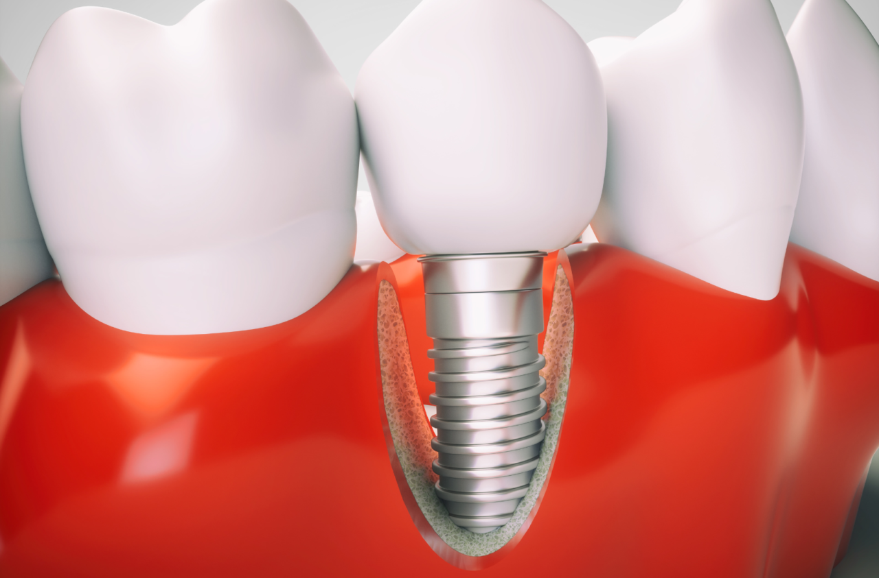 Dental-Implants in chicopee, ma