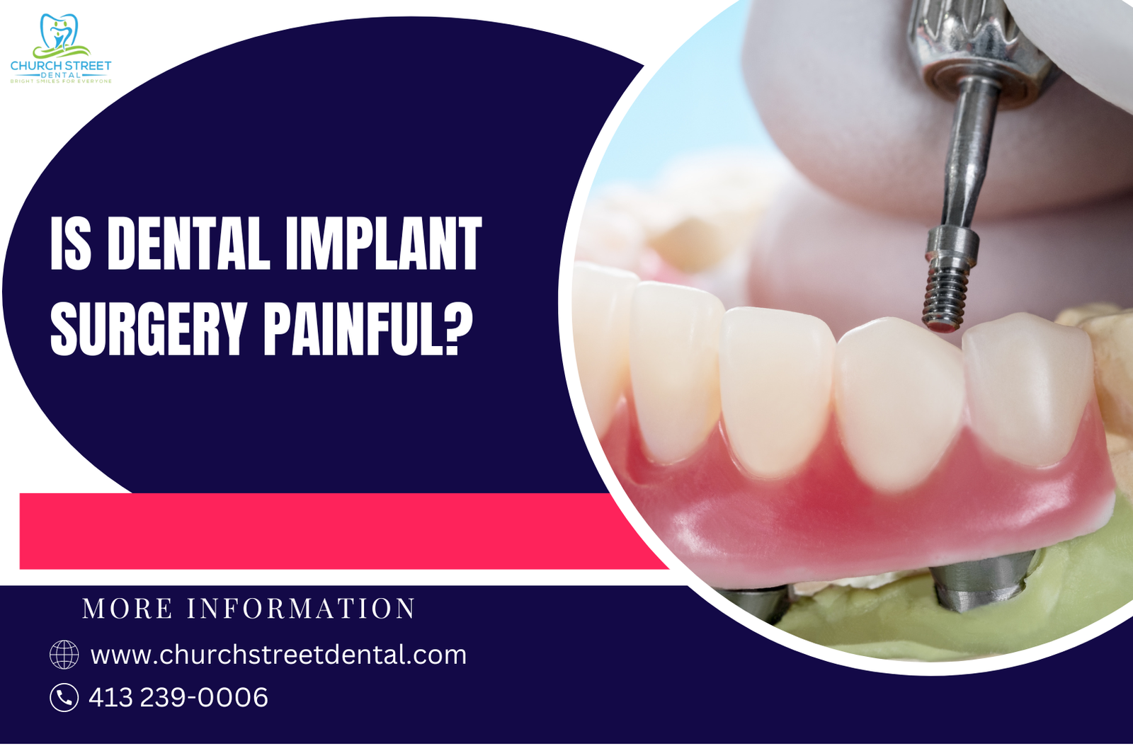 Dental Implants