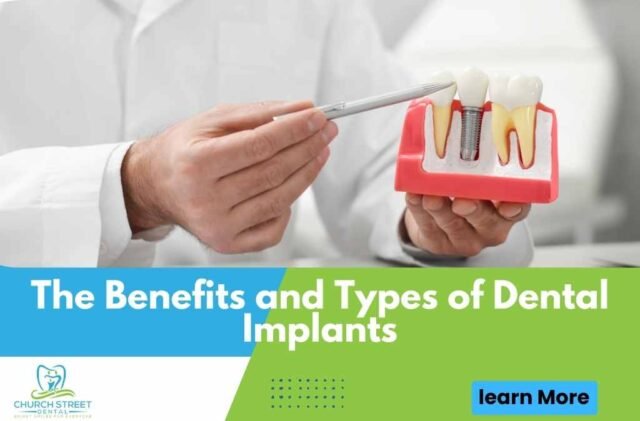 The Benefits and Types of Dental Implants