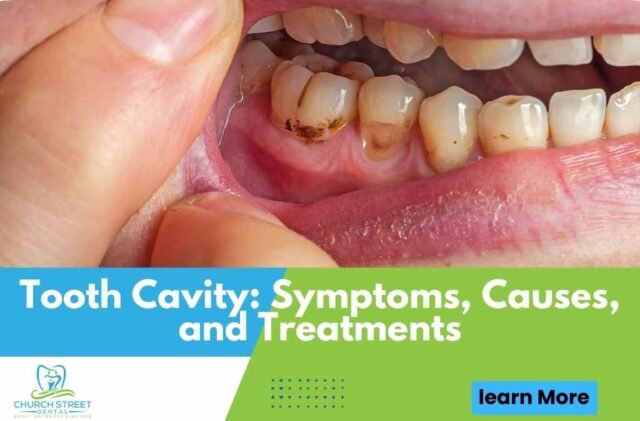 Tooth Cavity: Symptoms, Causes, and Treatments