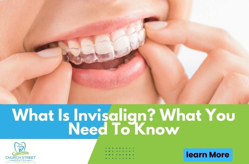 What Is Invisalign? What You Need To Know