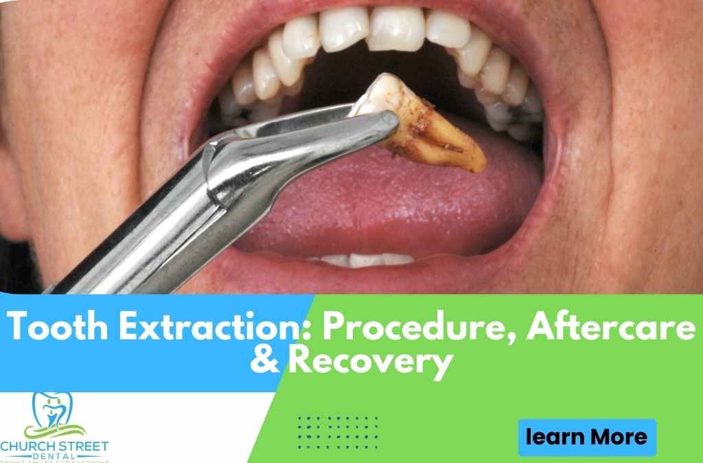 Tooth Extraction: Procedure, Aftercare & Recovery